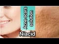 Acne scars treatment Niacid By Slurp kitchen foodies