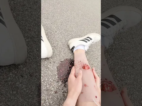🚑 POV: First Aid for an Open Leg Fracture - What to Do? #ambulance #paramedic #emergency #firstaid