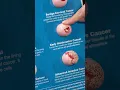 Download Lagu Stages of cervical cancer - From benign to advanced | UC Davis Health Tips