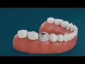 Aspen Dental Crowns