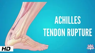 Download Achilles tendon rupture, Causes, Signs and Symptoms, Diagnosis and Treatment MP3