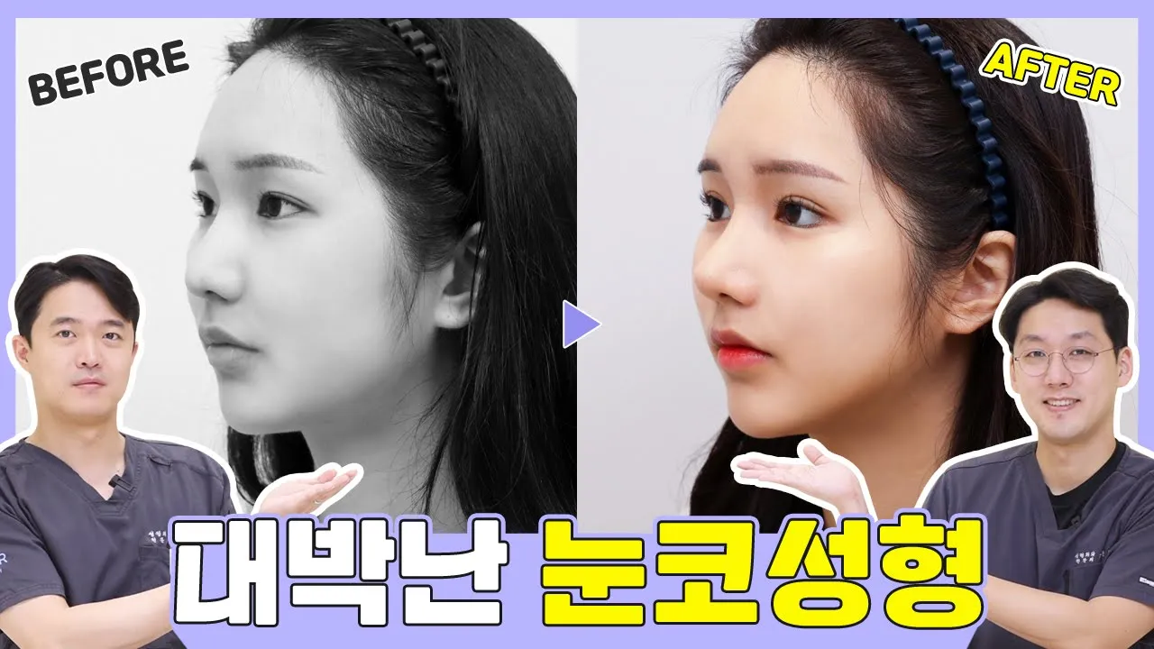 대박 난 눈코 성형 케이스 리뷰 │ 눈매교정 변화 과정 │ 무보형물 코성형 변화 과정