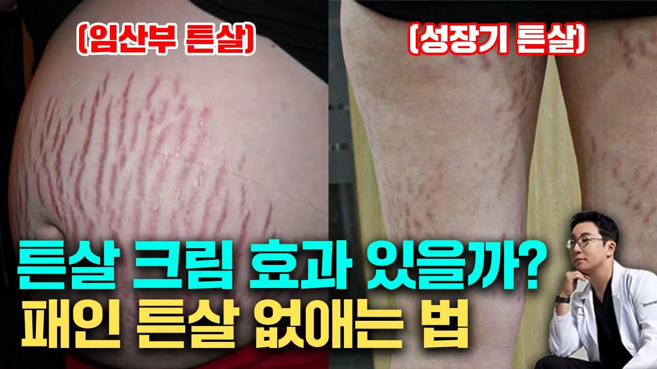 성장기 튼살, 튼살 없애는 방법과 관리 예방법, 튼살 치료 시기(피부과 전문의 오가나)
