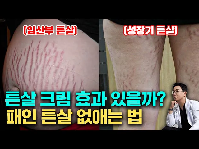 성장기 튼살, 튼살 없애는 방법과 관리 예방법, 튼살 치료 시기(피부과 전문의 오가나)