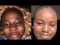 Download Lagu Ondoa chunusi sugu makovu bila kubadili rangi hapa