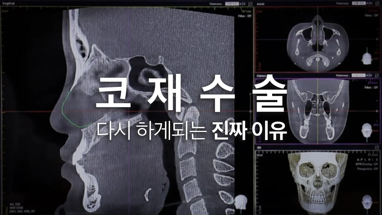 코 성형 재수술👃🏻