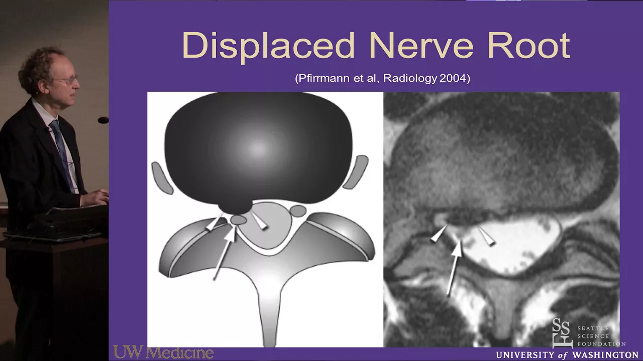 Endoscopic Spine Surgery - Herniated Nucleus Pulposus (HNP) End Plate Fragment. 