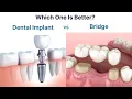 Lagu Dental Implant vs Bridge. Which one is better to replace a missing tooth?