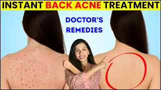 Instant Back Acne Treatment How To Treat Back Acne Back Acne Treatment Home Remedies Skincare 