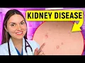 17 Signs of KIDNEY DISEASE You Can See Doctor Explains