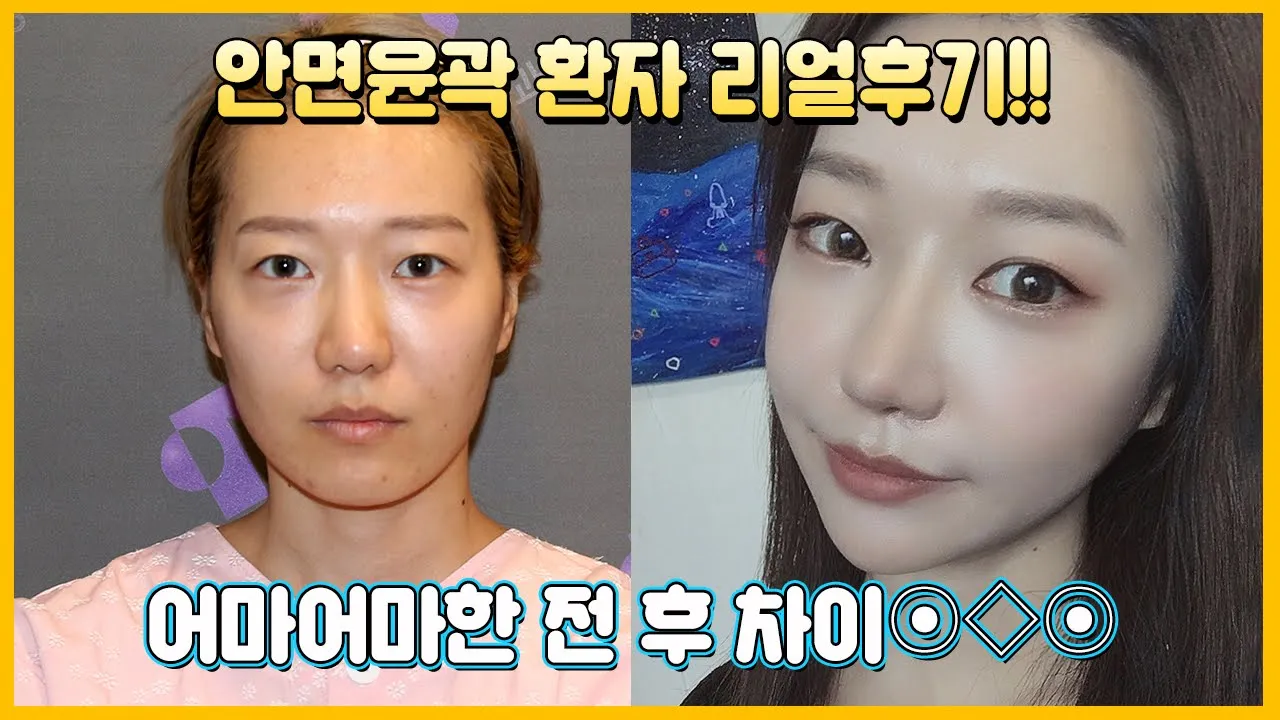 안면윤곽3종(+지방이식) 수술 후 U라인에서 V라인으로 돌아온 6달차 영상!