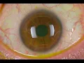 Orbitotomy CPT code - simplify medical coding