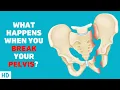 From Pain to Progress Overcoming a Pelvic Fracture