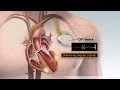 Cardiac Resynchronization Therapy
