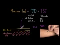 Mantoux Test aka PPD or TST