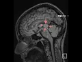 Pineal cyst