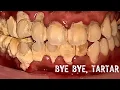 Download Lagu Tartar Removal Before and After - Satisfying video #021