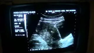 DIFFUSE MYOMETRITIS post D and C