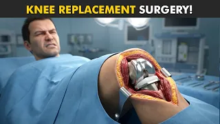 What Happens During Knee Replacement Surgery? (3D Animation)