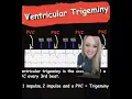 Ventricular Trigeminy EMS Cardiology