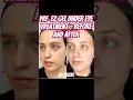 Download Lagu PRF EZ Gel Under Eye Treatment ~All Natural #undereyetreatment #undereyecircles #allnatural