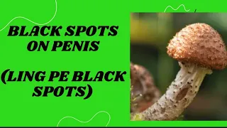 Black spots on the penis melanosis