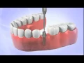 Dr Jin Kim Shares an Illustration of A Dental Implant in Diamond Bar CA