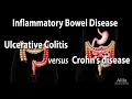 Download Lagu Ulcerative Colitis versus Crohn's Disease, Animation