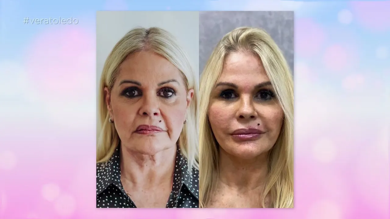 Programa Vera Toledo: Confira excelentes dicas para reduzir as rugas faciais