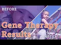 AADC Deficiency Before and After Gene Therapy