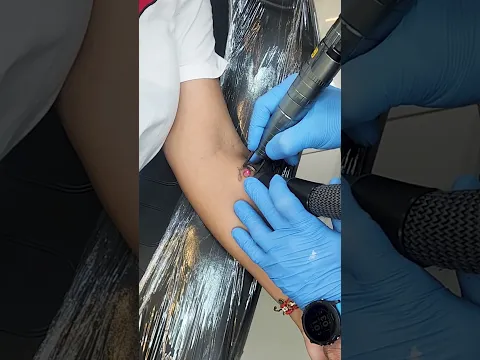 Remoção a laser de tatuagem no antebraço ⚡🖤| Remoção de Tatuagem
