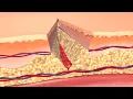 How Your Body Heals Cuts Scrapes and Puncture Wounds to the Skin