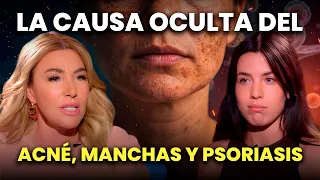182. La Causa Oculta Del Acné, Manchas y Psoriasis con Maria Puntí