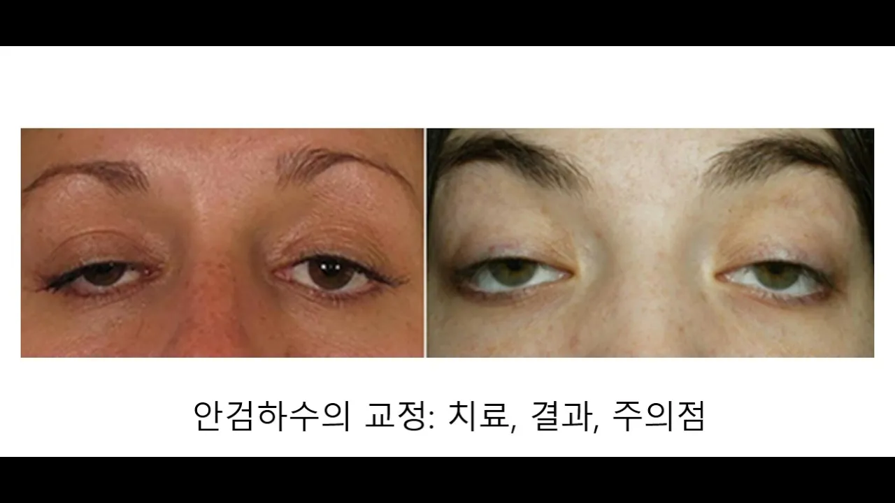 안검하수 교정(2)수술방법, 결과, 주의점