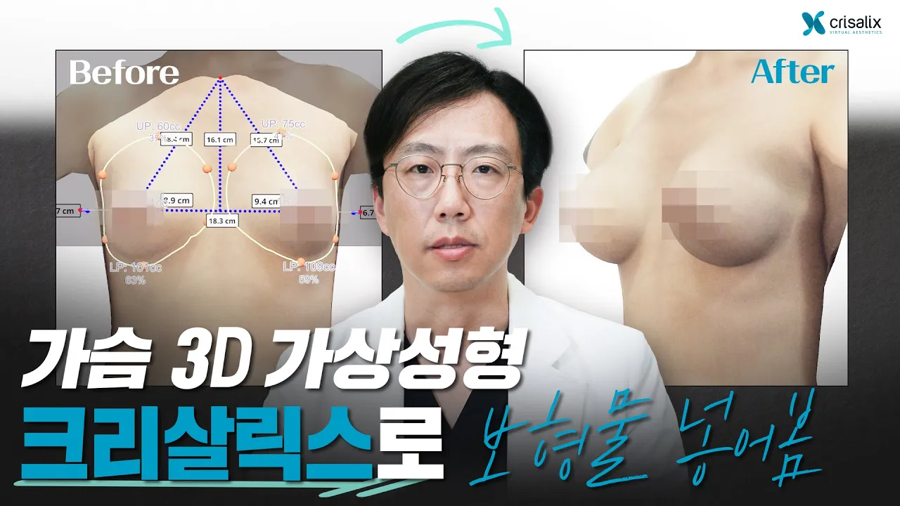 ✨3D 가상성형으로 보형물을 넣어보았다! 내가 짝가슴이라고??🙄😣 [가슴성형] #그레이스성형외과 #최문섭원장님 #닥터초이