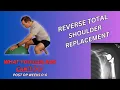 WHAT YOU CAN AND CAN T DO AFTER HAVING A REVERSE TOTAL SHOULDER REPLACEMENT POST OP WEEKS 0-6