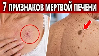 7 главных признаков УМИРАЮЩЕЙ ПЕЧЕНИ! Как вовремя проверить здоровье печени?