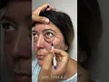 Download Lagu Lower Eye Bag Removal Before and After - Kami Parsa