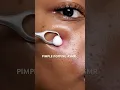 Download Lagu Pimple Popping ASMR Skincare Melanin Skin | Uneven Skin Tone AI Clear Skin Products for dark skin