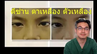 สาเหตุหลักของโรคดีซ่านมีอะไรบ้าง และแต่ละแบบเกิดจากอะไร