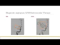 AANS Coding Shorts Middle Cerebral Artery Thrombectomy