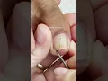 Download Lagu Pedicure on Fungal Toenails before \u0026 after 1st visit