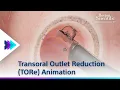 Download Lagu Transoral Outlet Reduction (TORe) Animation