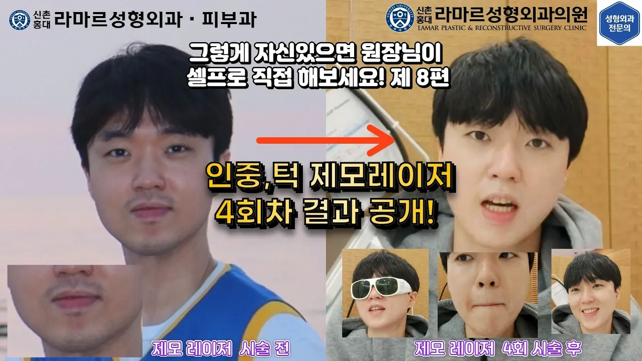 [모영웅 대표원장님 셀프시술 제8편] 인중, 아래턱 제모 4회차 결과 공개!