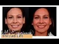 Thread Lift Review My Experience Nova PDO Threads for NonSurgical Facelift