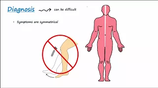 متلازمة غيلان باريه        وصف موجز  دندنها