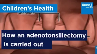 How an adenotonsillectomy is carried out Bupa Health