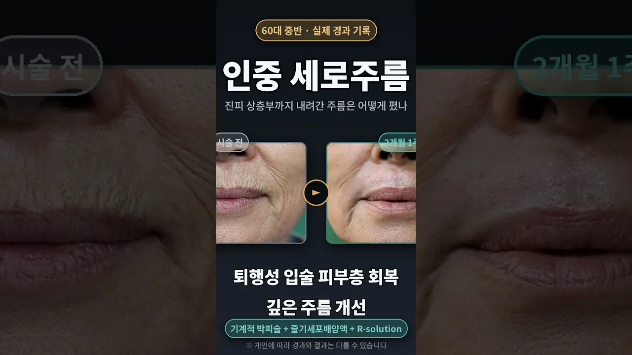 인중 세로주름, 2주와 2개월의 차이  #연세자연미#입술고양이주름 #인중세로주름