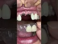 Download Lagu For temporary teeth for implants!