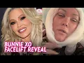 Bunnie Xo Shares Unfiltered Facelift Recovery After Jelly Roll Drama
